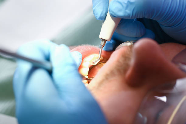 Best Emergency Treatment for Dental Infections or Abscesses in Clawson, MI