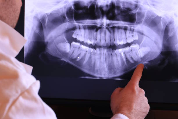 Best Emergency Wisdom Teeth Removal in Clawson, MI